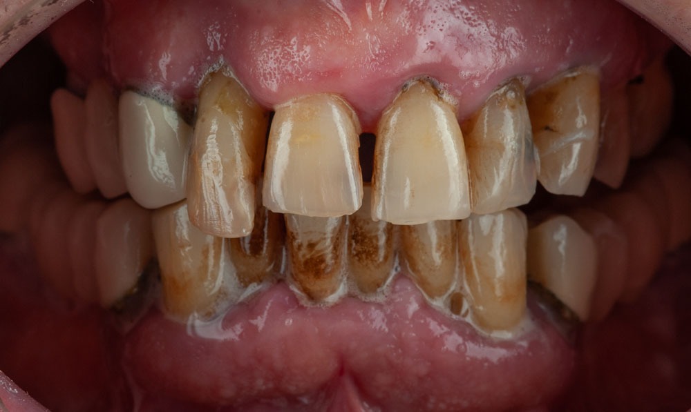 paciente pedro implantes dentales clinica dental corbella-1