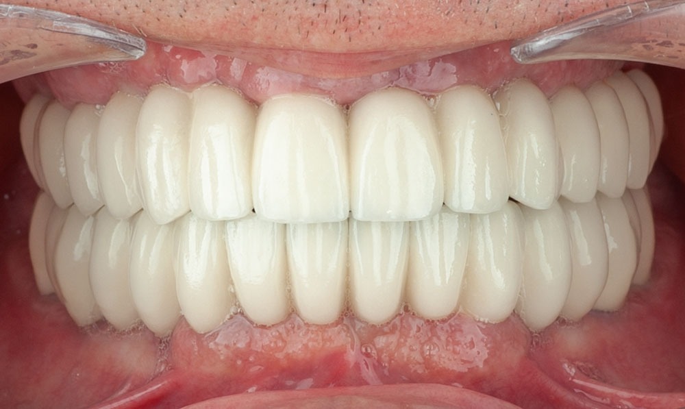 paciente pedro implantes dentales clinica dental corbella-2