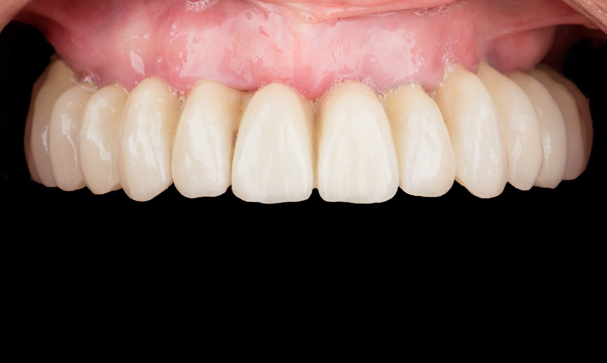 paciente selene implantes dentales clinica dental corbella-1