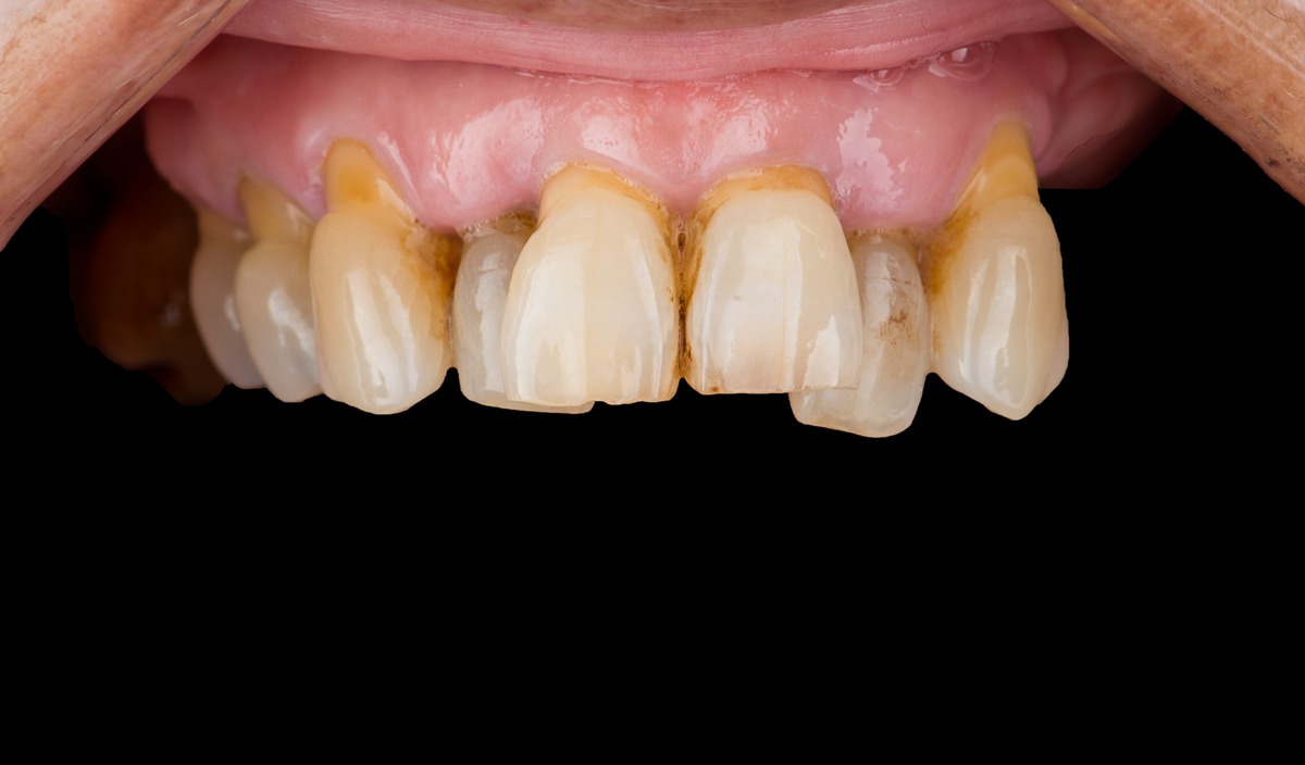 paciente selene implantes dentales clinica dental corbella