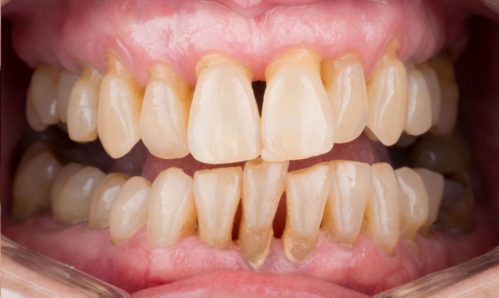 paciente sofia implantes dentales clinica dental corbella-1
