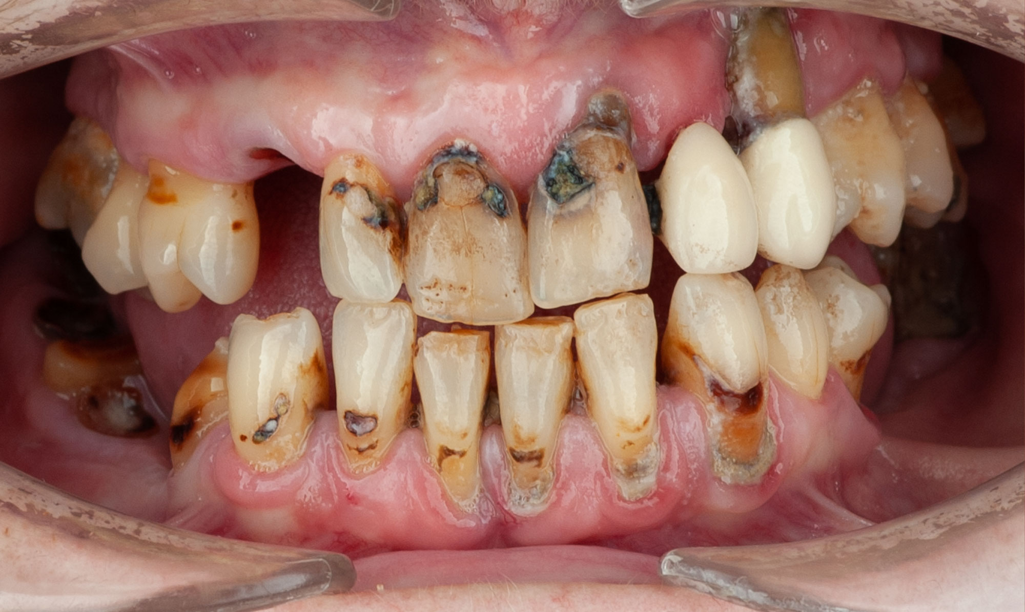 paciente sofia implantes dentales clinica dental corbella-3