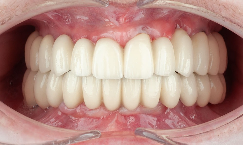 patient sofia dental implants dental clinic corbella-4