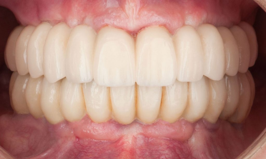 paciente sofia implantes dentales clinica dental corbella