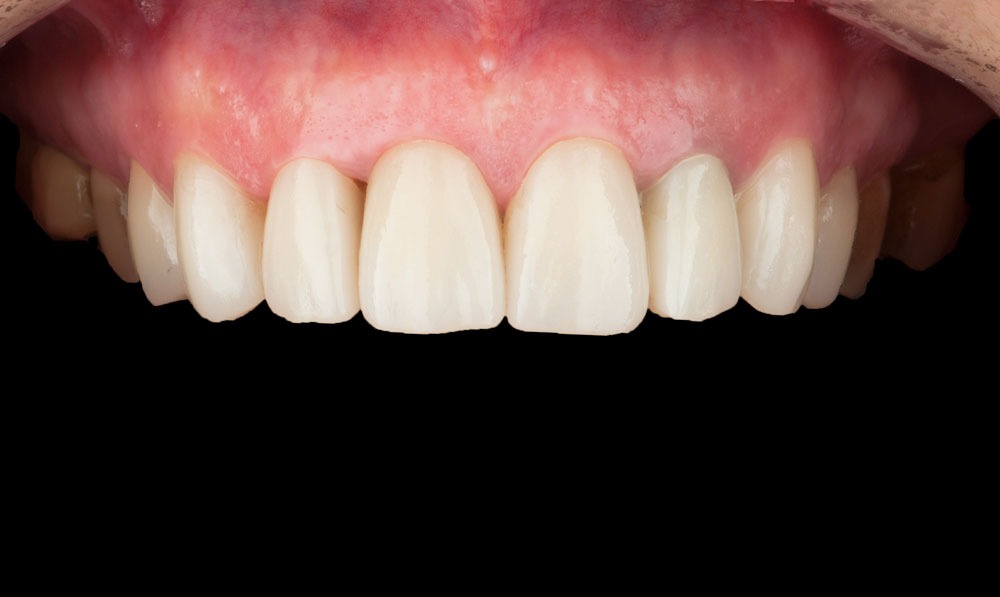 paciente vanesa implantes dentales clinica dental corbella-1