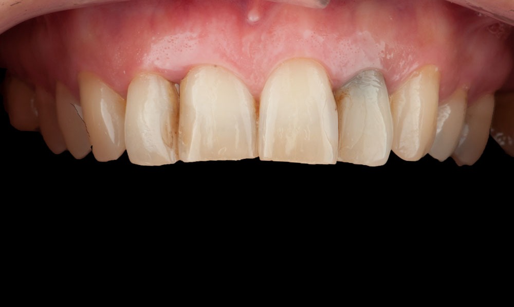 paciente vanesa implantes dentales clinica dental corbella