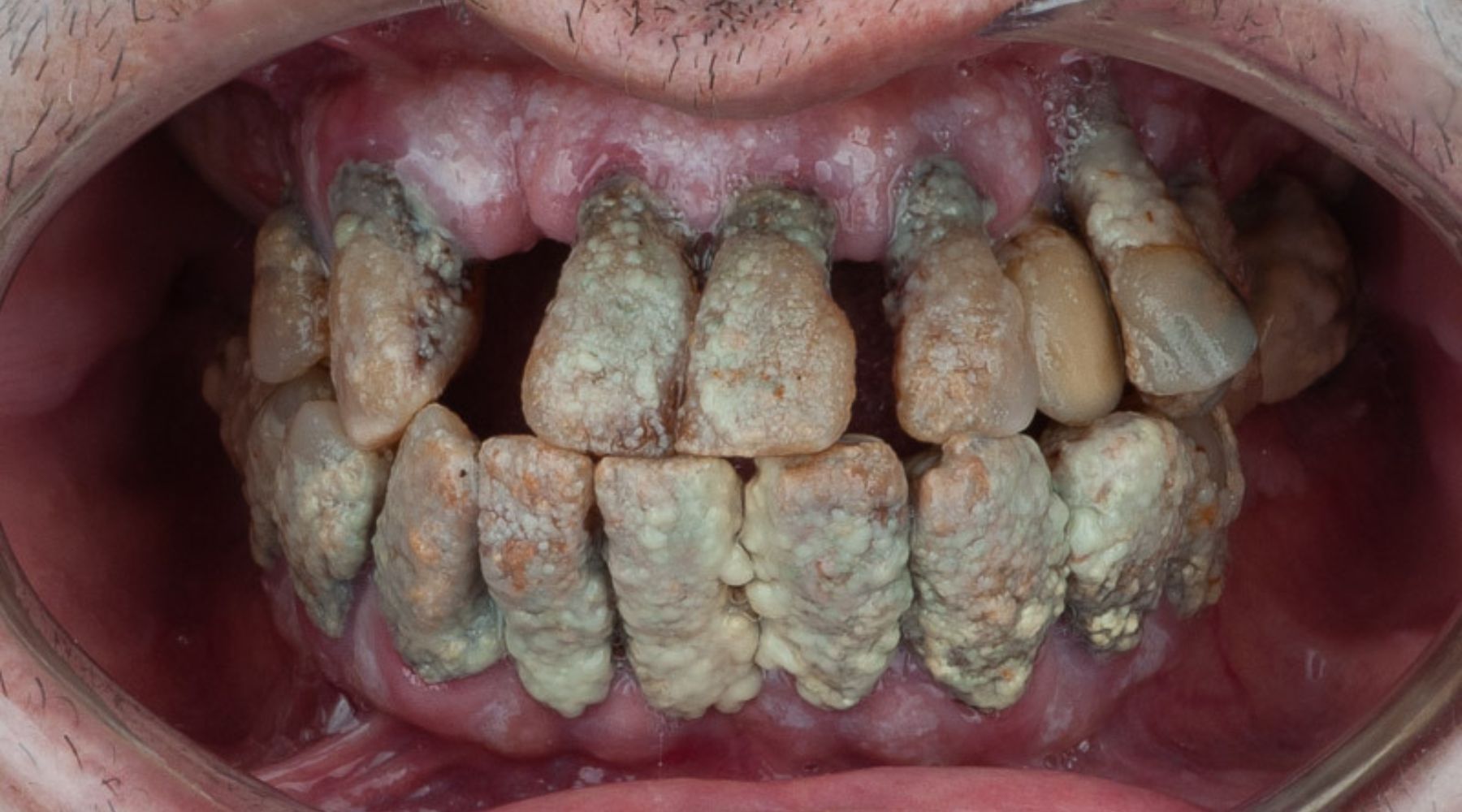 implantes cigomáticos dental corbella