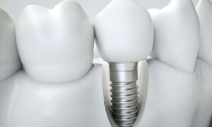 ¿Cómo prevenir el rechazo de un implante dental? Cuidados antes y después de la cirugía