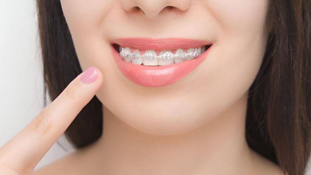 beneficios gomas brackets