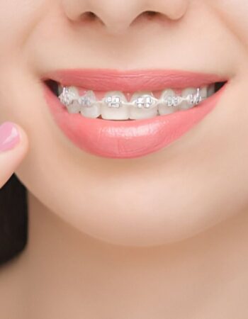 Gomas para Brackets en ortodoncia ¿Qué son?