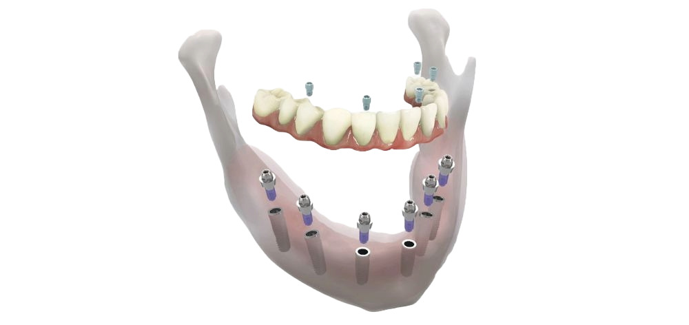 ventajas implantes boca completa