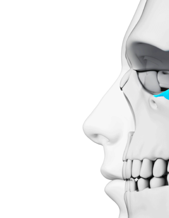 Implantes Dentales Sin Hueso: Diferencia entre Cigomáticos y Pterigoideos