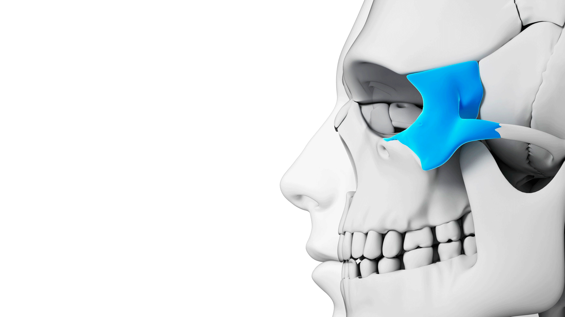 Implantes Dentales Sin Hueso: Diferencia entre Cigomáticos y Pterigoideos