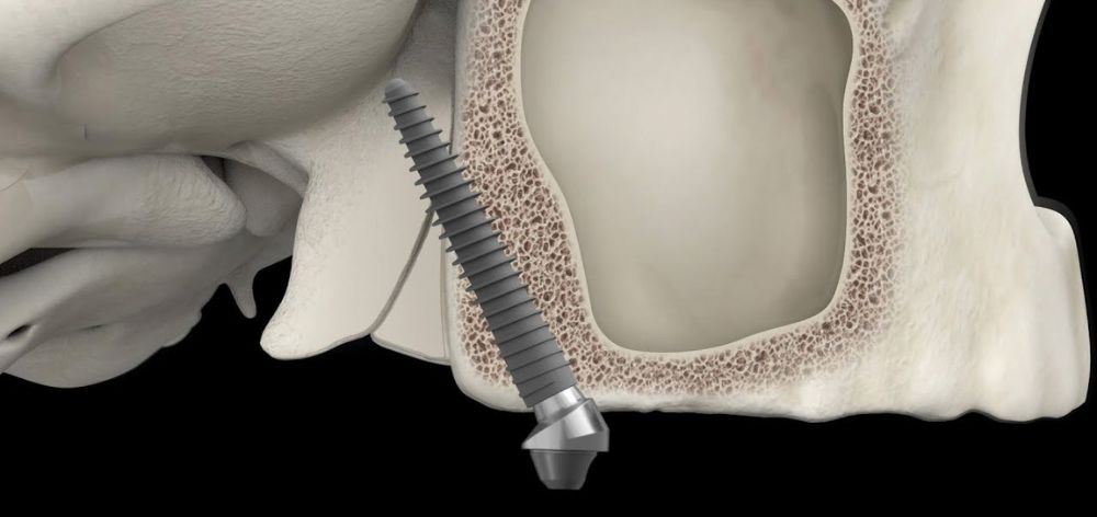 diferencias implantes dentales