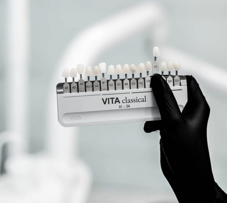 Blanqueamiento-dental