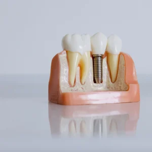 Precio de los implantes dentales: factores que influyen y consejos para planificar tu tratamiento