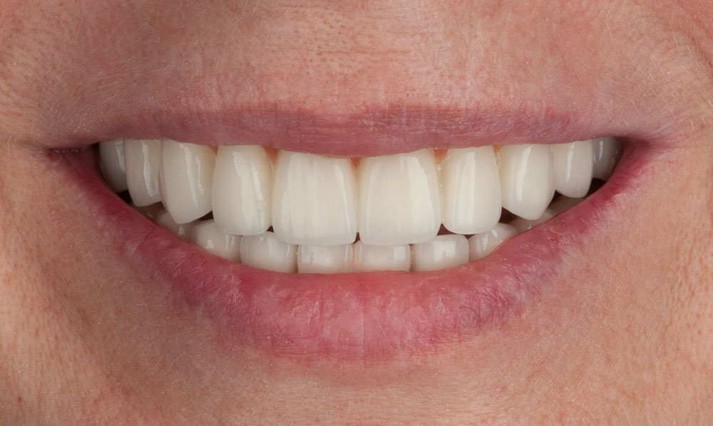 sonrisa-despues-margarita