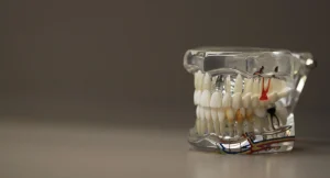 Tipos de implantes dentales: guía para elegir la mejor opción según tu caso