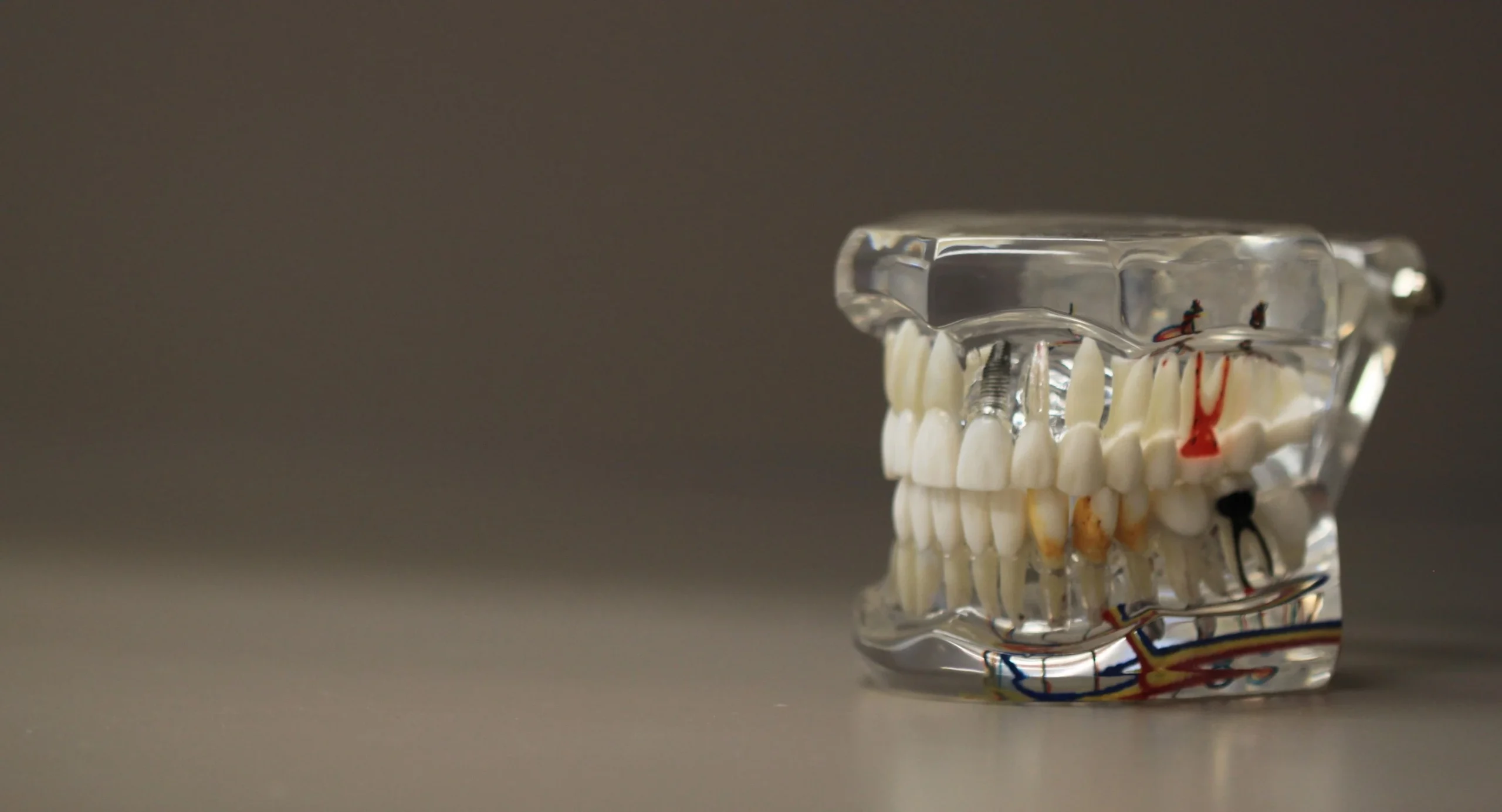 Tipos de implantes dentales: guía para elegir la mejor opción según tu caso