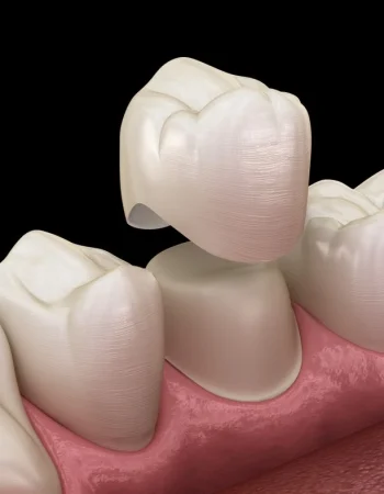 Coronas dentales: qué son, tipos y cuándo se necesitan