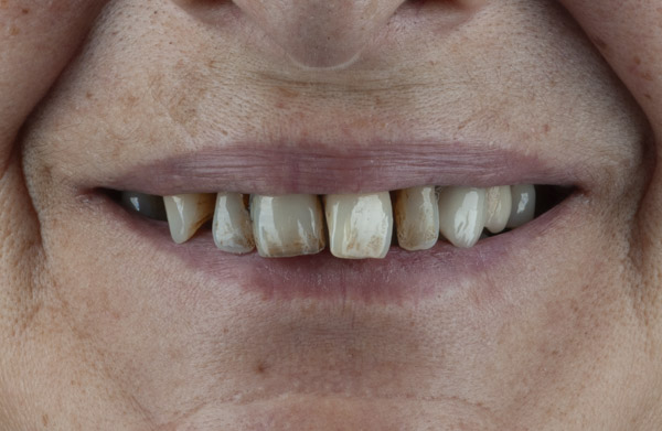 antes-slider-ana-bujan