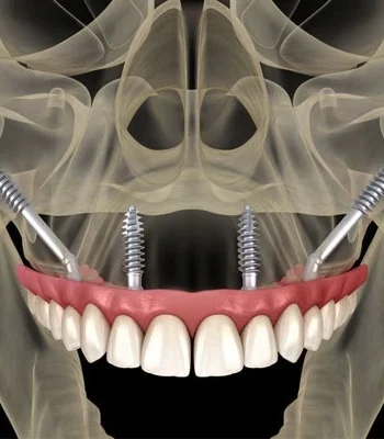 Implantes en el maxilar superior: ¿por qué los cigomáticos pueden ser la solución?