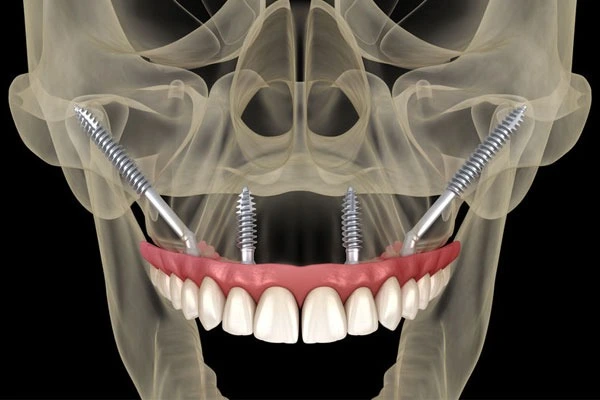 Implantes en el maxilar superior: ¿por qué los cigomáticos pueden ser la solución?