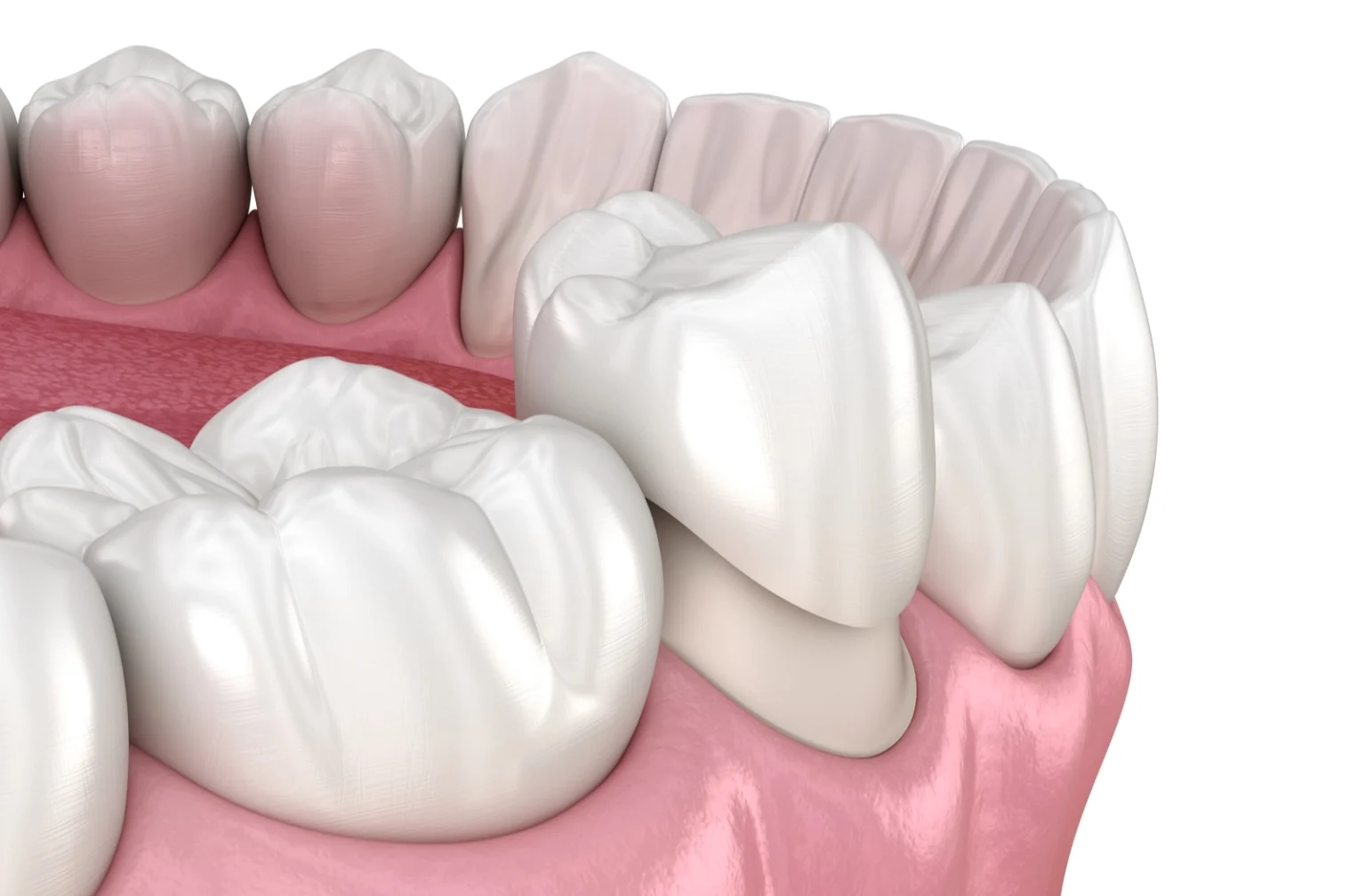 coronas-dentales-dentalcorbella