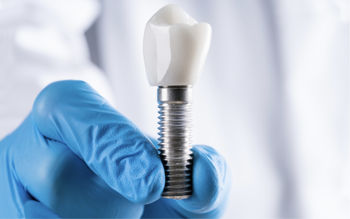 Rechazo del implante dental: causas, síntomas y cómo prevenirlo