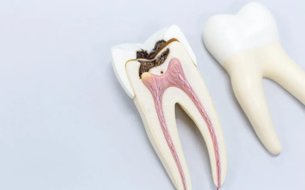 endodoncia-dental-corbella