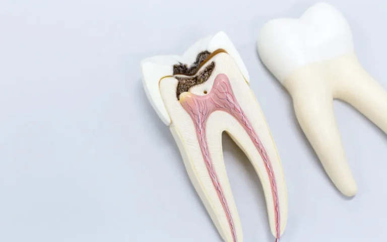 endodoncia-dental-corbella