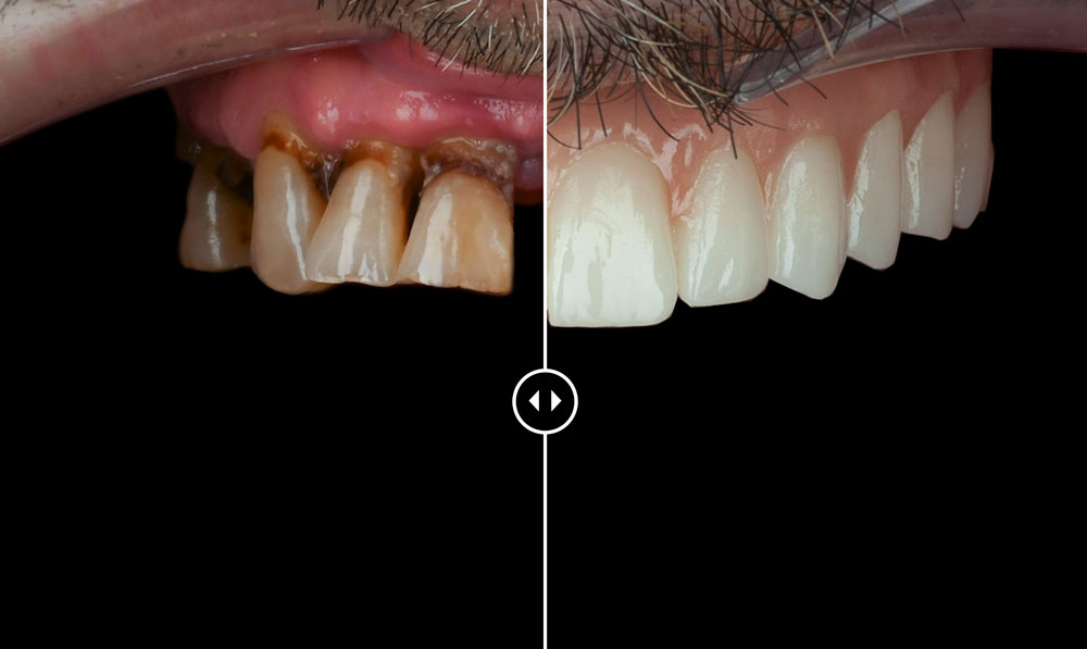 Roberto – Implantes Dentales