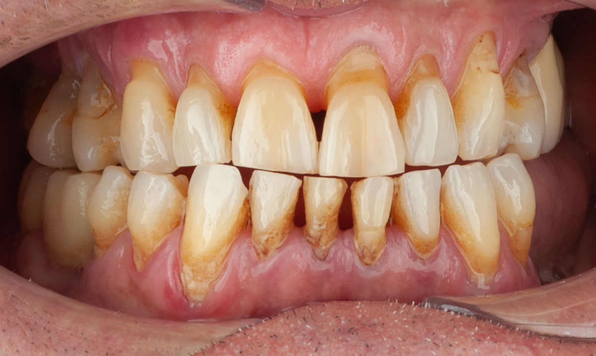 Pedrodebenitoa-intra-antes