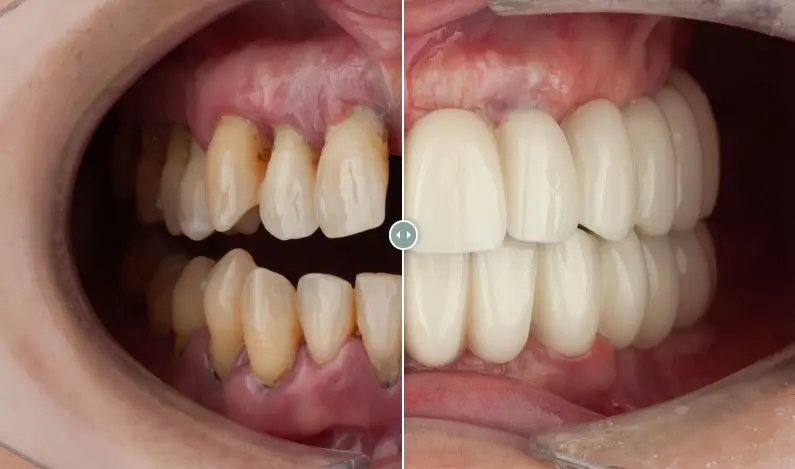 Esther – Implantes dentales