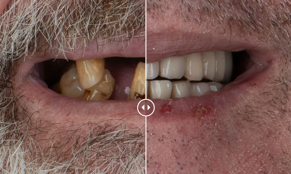 Pedro  – Implantes dentales