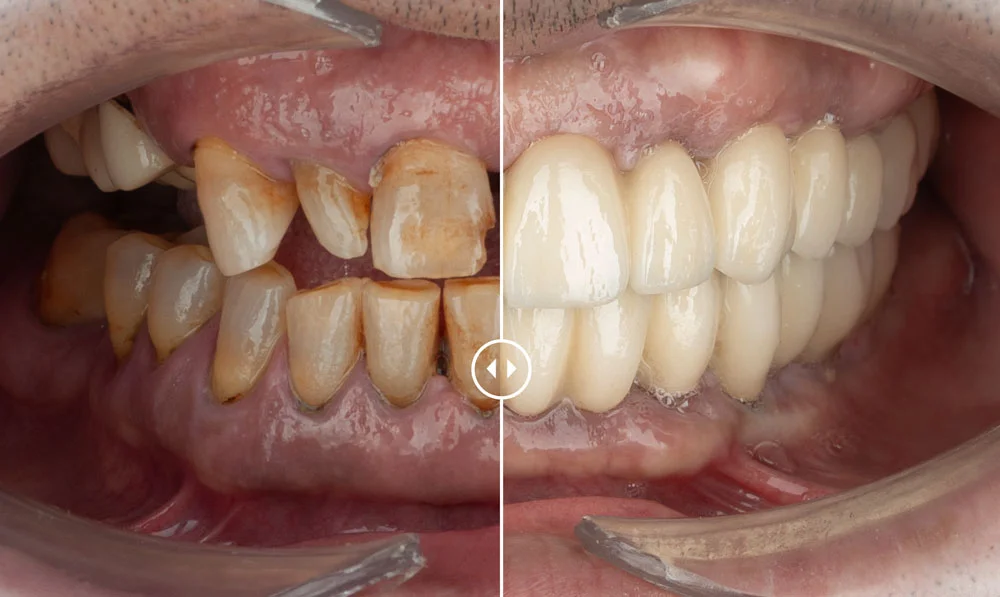 Jorge – Implantes dentales
